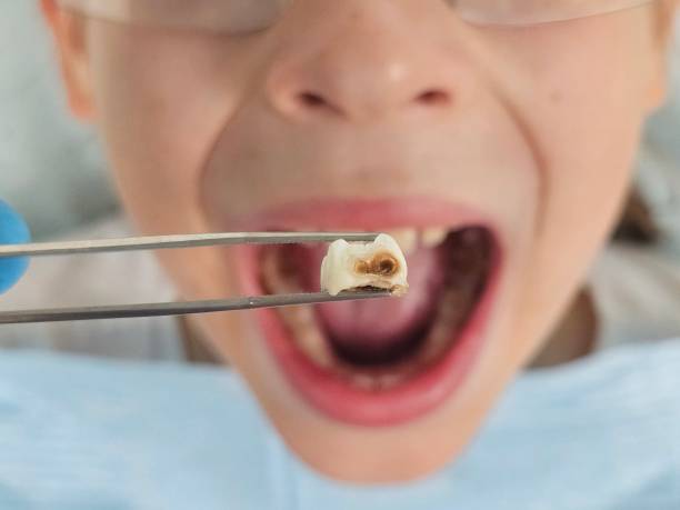 Best Urgent Care for Lost Fillings or Crowns in West Carthage, NY